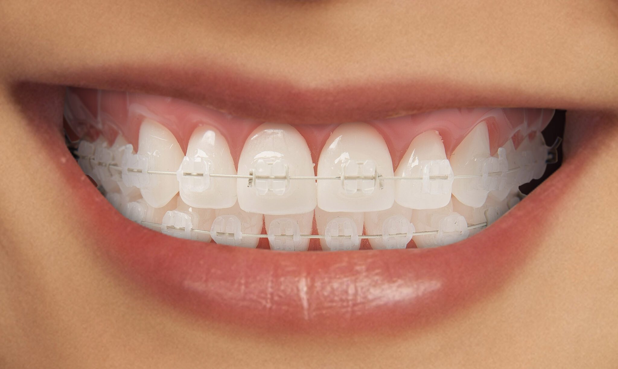 Adult Braces Tender Care Dental 2666