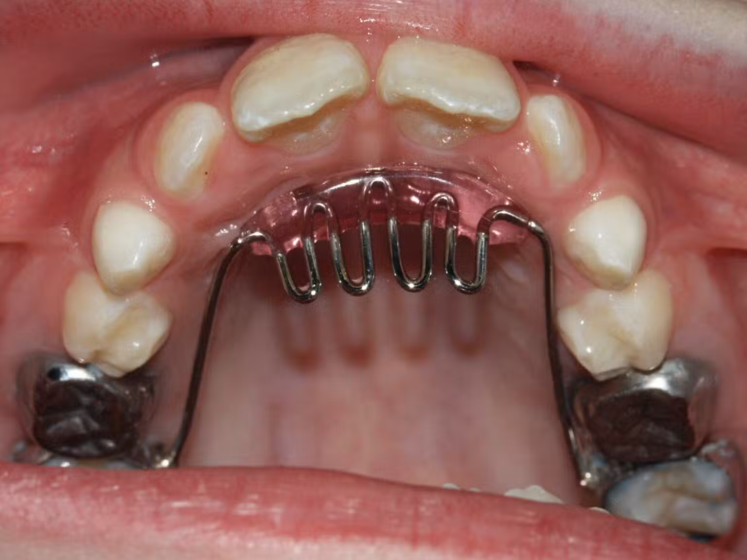 habit breaker for thumb sucking appliance